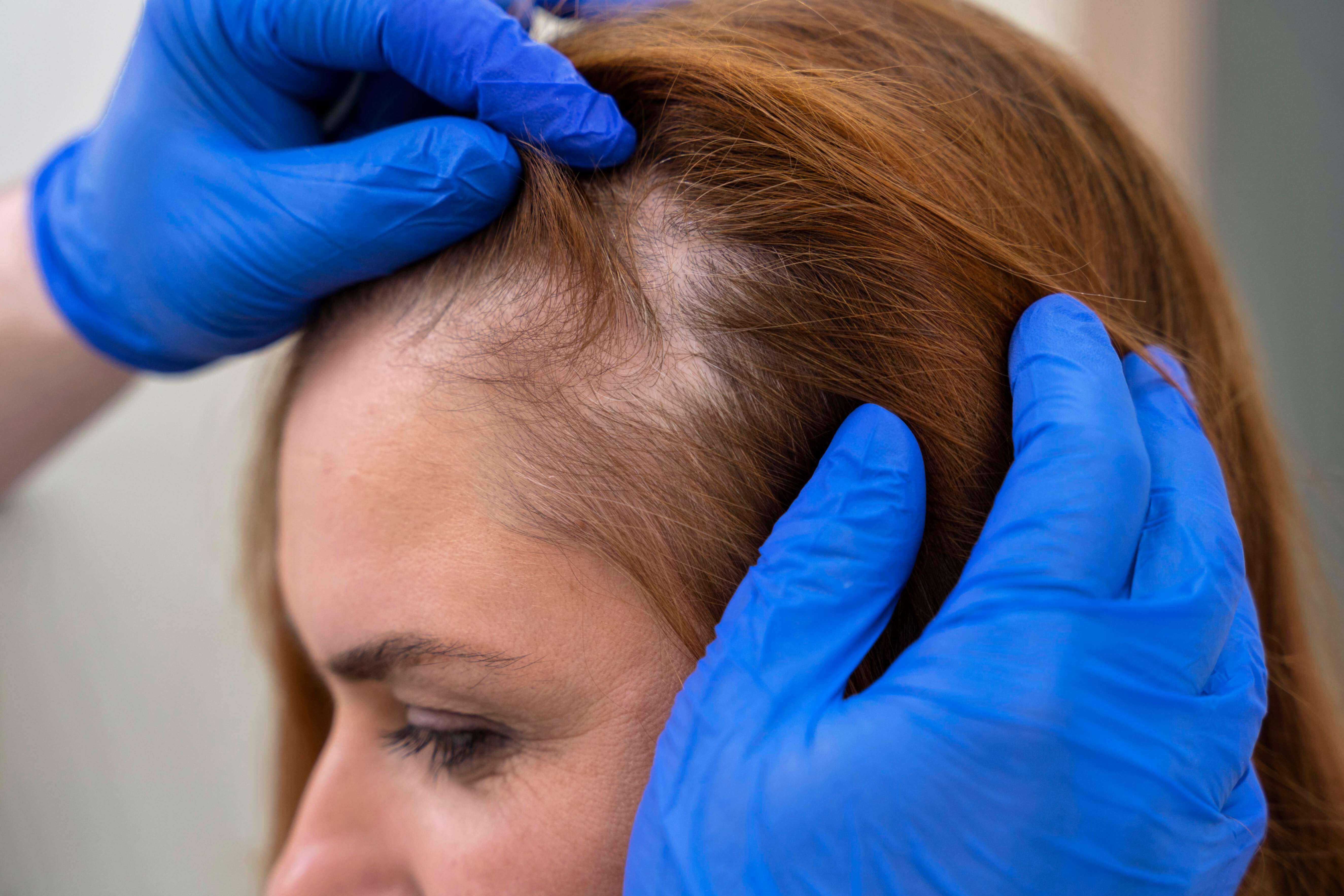 Dermatologist checking a patient’s scalp to explain how much hair loss is normal.