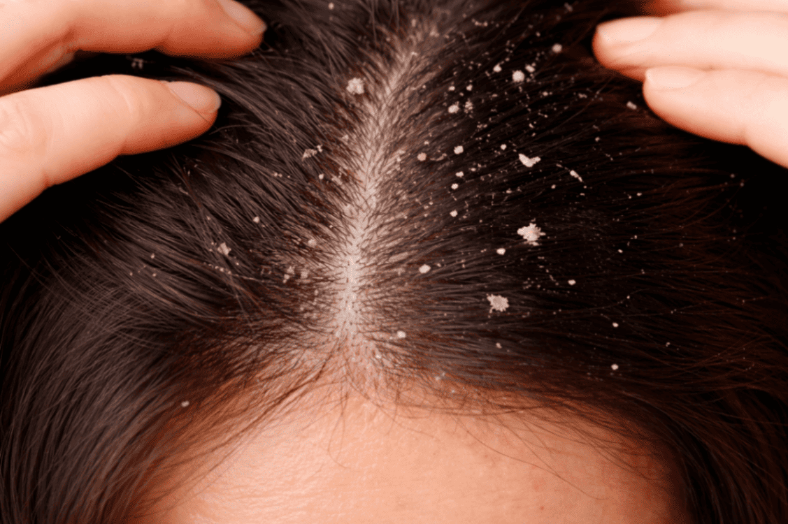 a woman with psoriasis in need of deep scalp cleansing