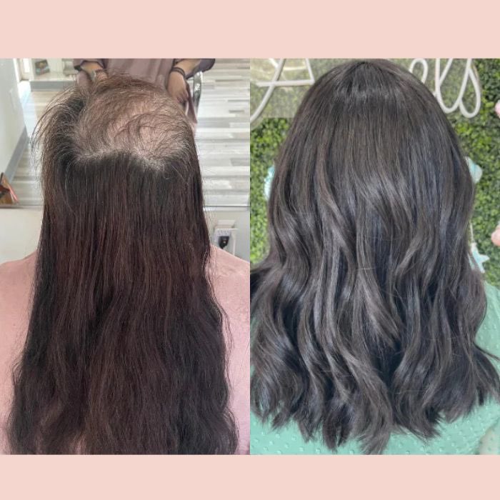 Trichotillomania client testimonial